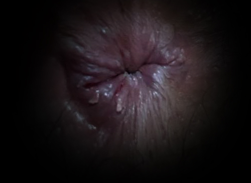 早期肛门尖锐湿疣图片